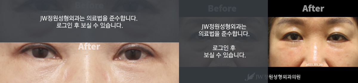 눈밑 노화의 원인 - 로그인 후 보실 수 있습니다.