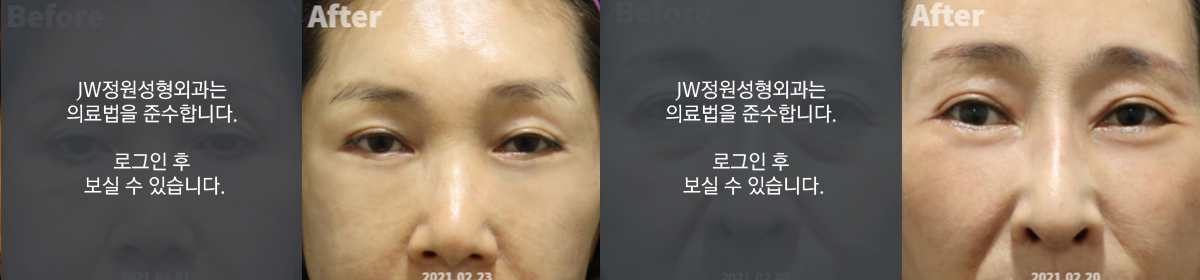 피부절제 - 로그인 후 보실 수 있습니다.