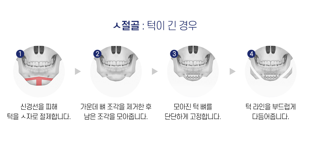 ㅅ절골