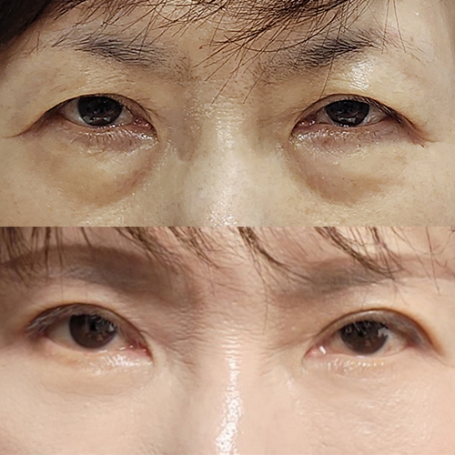 눈썹하거상, 하안검 중안면거상 