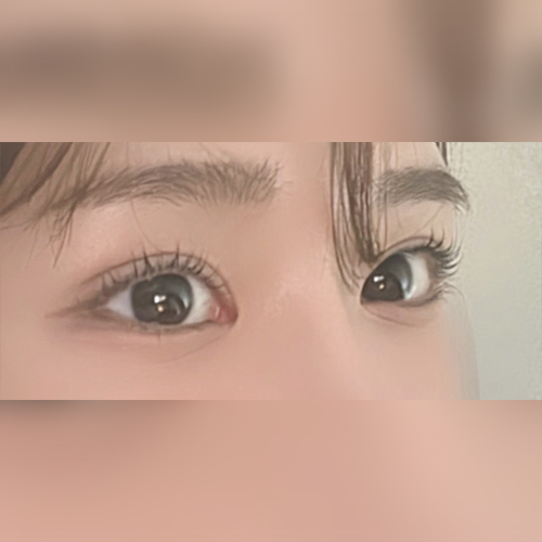 눈재수술, 매몰