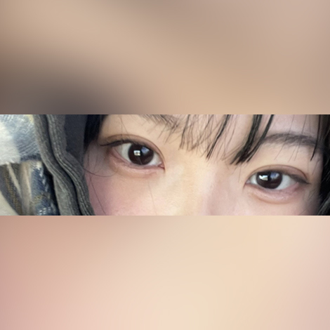 매몰쌍꺼풀