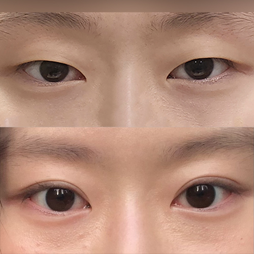 절개 눈매교정